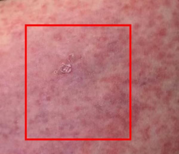 冲上热搜！女子养了这种宠物，脸烂成“火龙果”！这种宠物很多人家里都有！