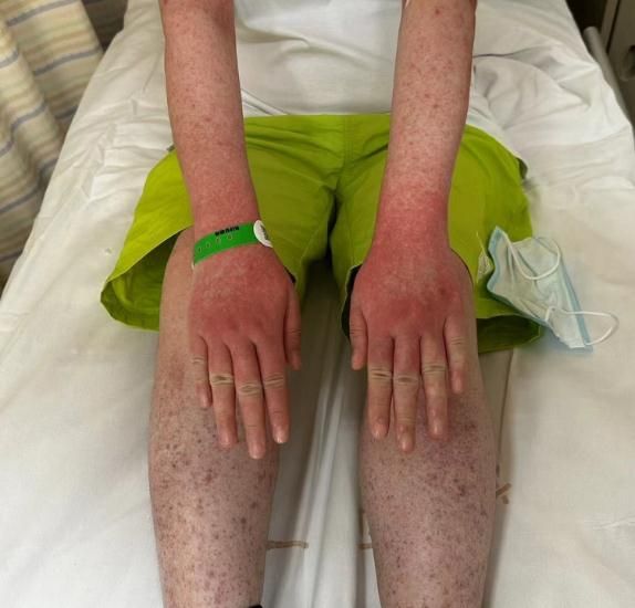 冲上热搜！女子养了这种宠物，脸烂成“火龙果”！这种宠物很多人家里都有！