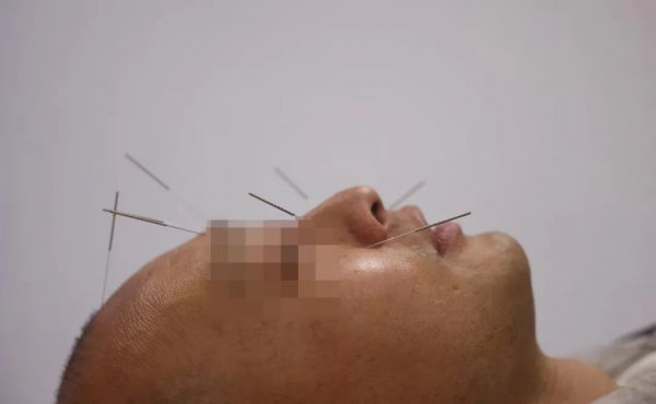 3月24日，北京，一名过敏患者在北京接受针灸治疗