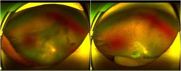 深圳8岁男孩确诊!严重可致失明,这类人群需警惕