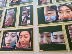 -华尊荣植物古法祛痣祛疣祛汗管瘤