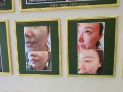 -华尊荣植物古法祛痣祛疣祛汗管瘤