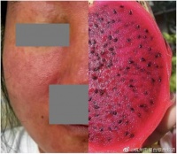 杭州女子养仓鼠脸烂成火龙果 养宠物要弄明白来历