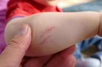 如果你被狗的爪子抓伤了