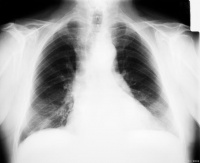 养宠物养出“肺癌”？医生忠告：家里养这种宠物的，要注意了