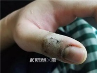 高中生养剧毒蝮蛇当宠物！掰开毒牙给蛇上药，结果被咬了…