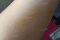 被宠物狗咬了一下有红印没事吧