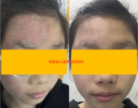 皮肤科：姐妹俩先后出现面部红斑瘙痒，竟是仓鼠惹的祸