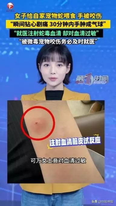 离谱！女生三周不喂宠物蛇，投喂时惨遭咬伤，险些危及生命